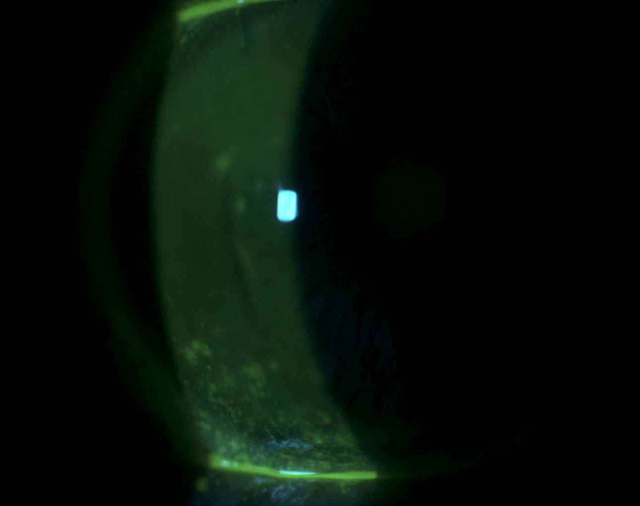 Inferior Corneal Staining in MGD